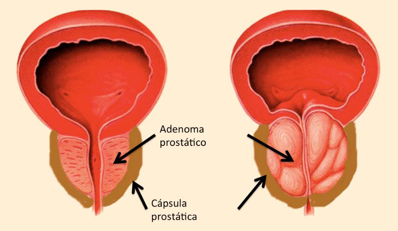 prostata adenom)