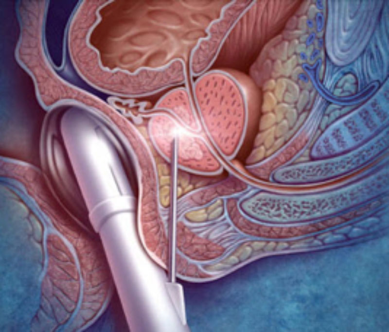 biopsia de prostata por fusion en mexico prostatita cronică capon