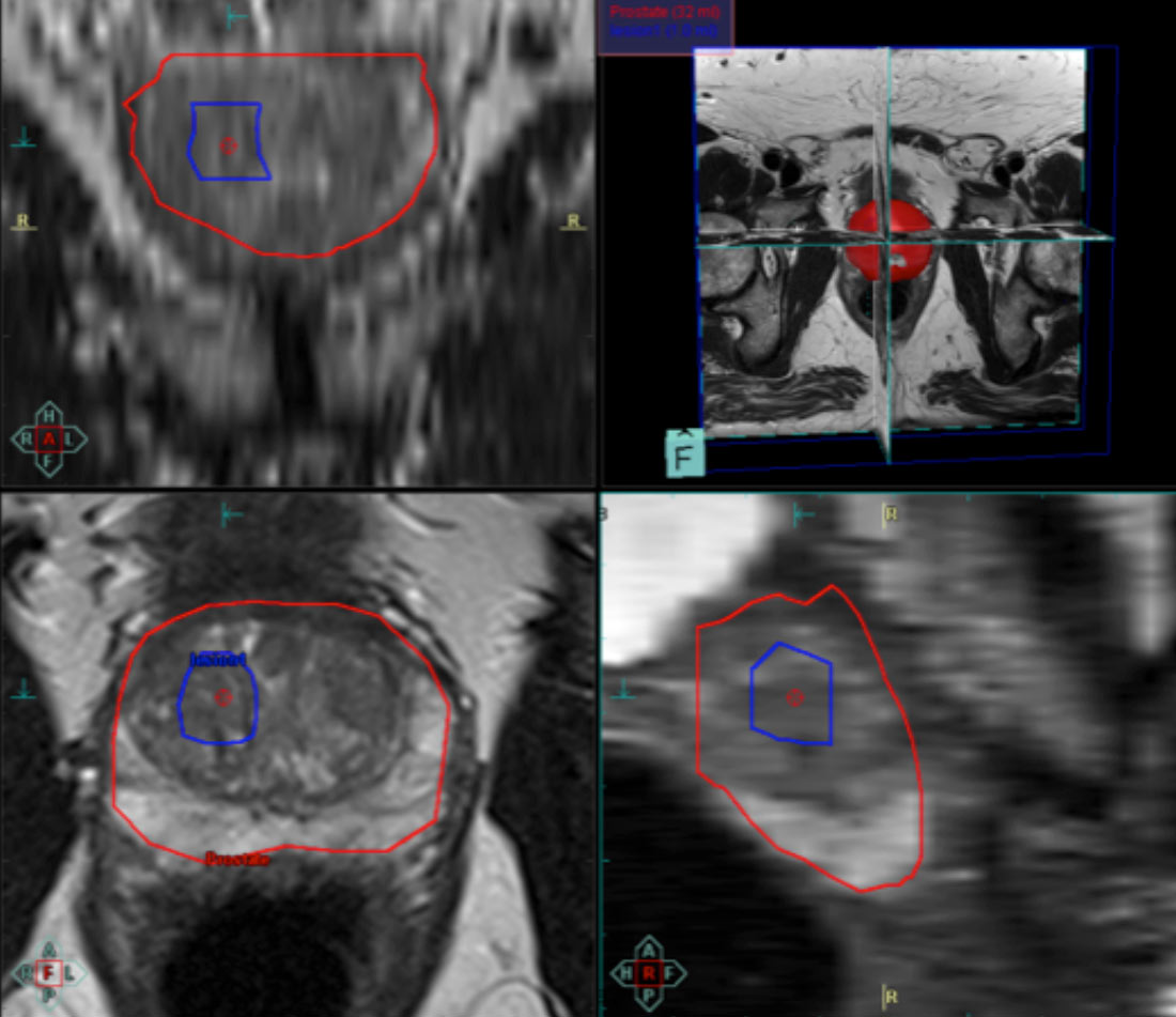 Cancer de prostata imagenes reales - Imagenes de papiloma en ano