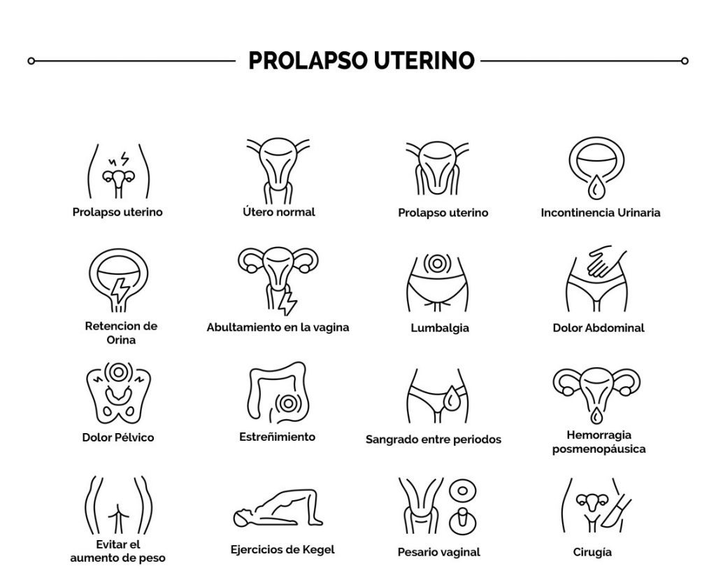 Prolapso de Órganos Pélvicos - Clínica Urosalud