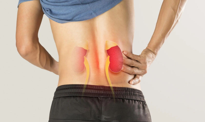 Cómo evitar que las piedras en el riñón vuelvan a aparecer